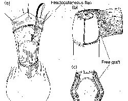 Is It Safe To Combine Foreskin Restoration And Penis Enlargement?